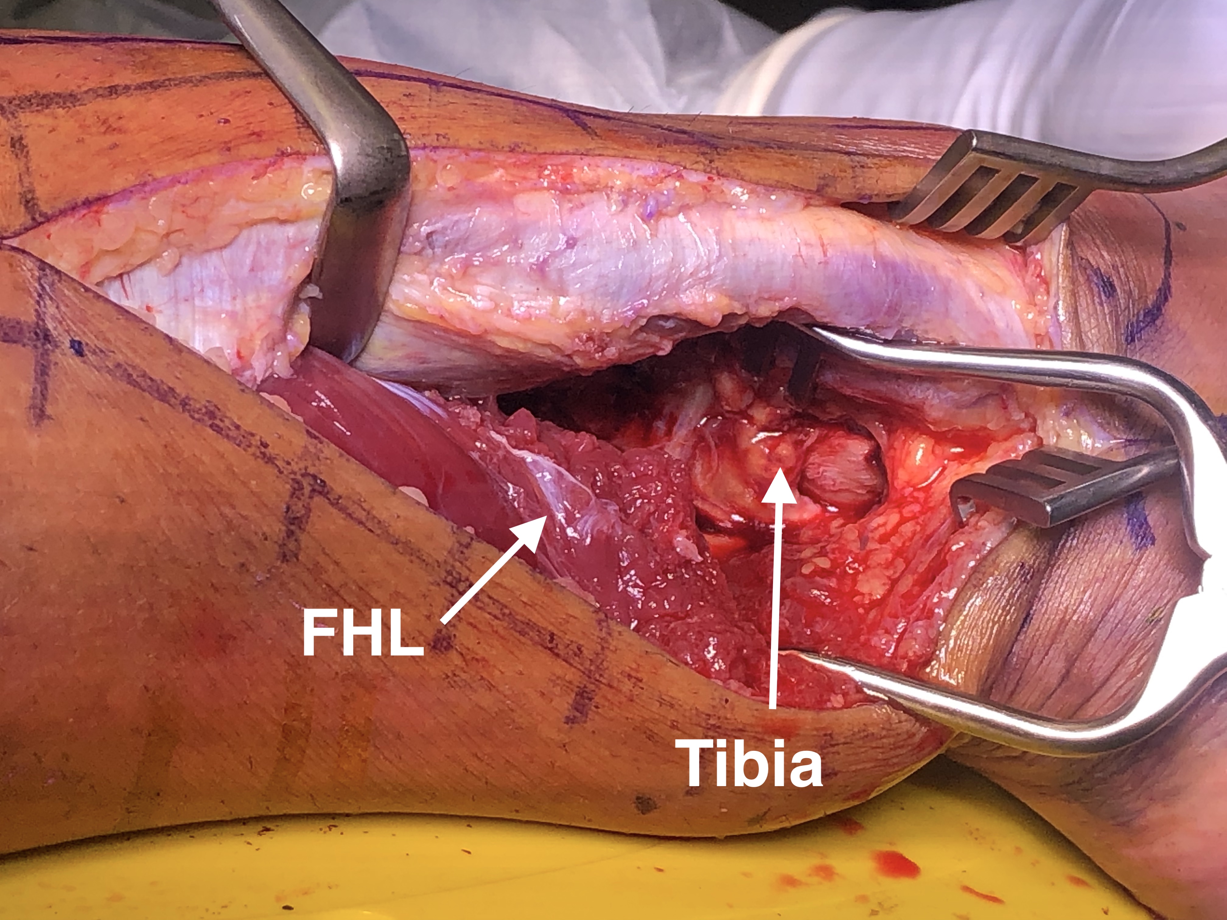 Ankle PL Approach 6